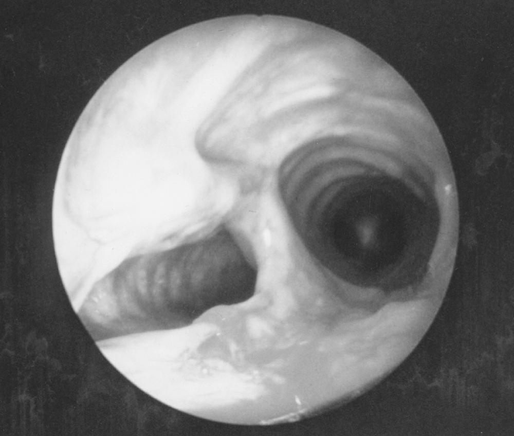 FIGURE 8-5, Endoscopic view of a tracheoesophageal fistula.