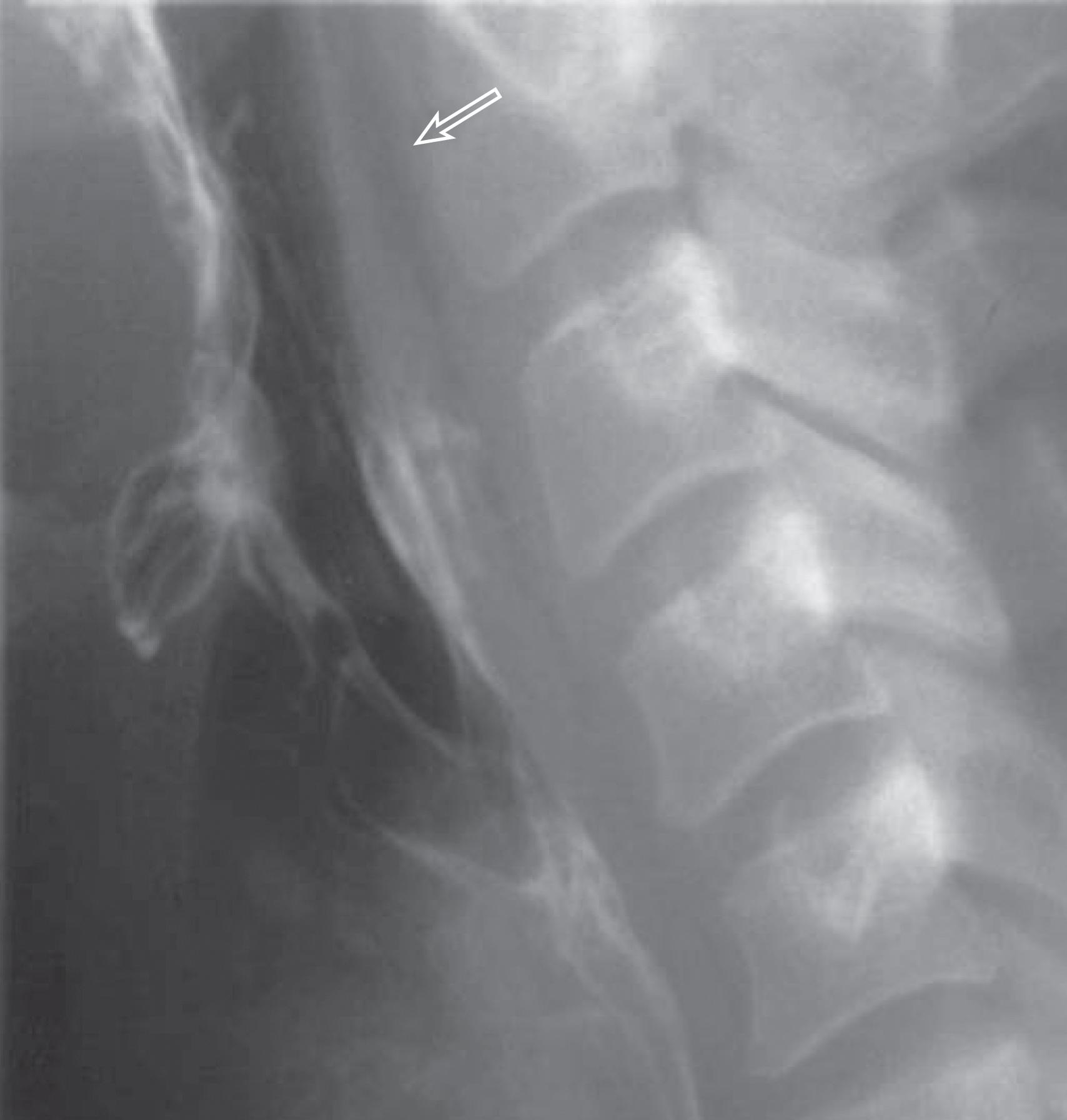 FIGURE 5, Retropharyngeal air (arrow) as seen on a lateral cervical spine radiograph/esophagogram.