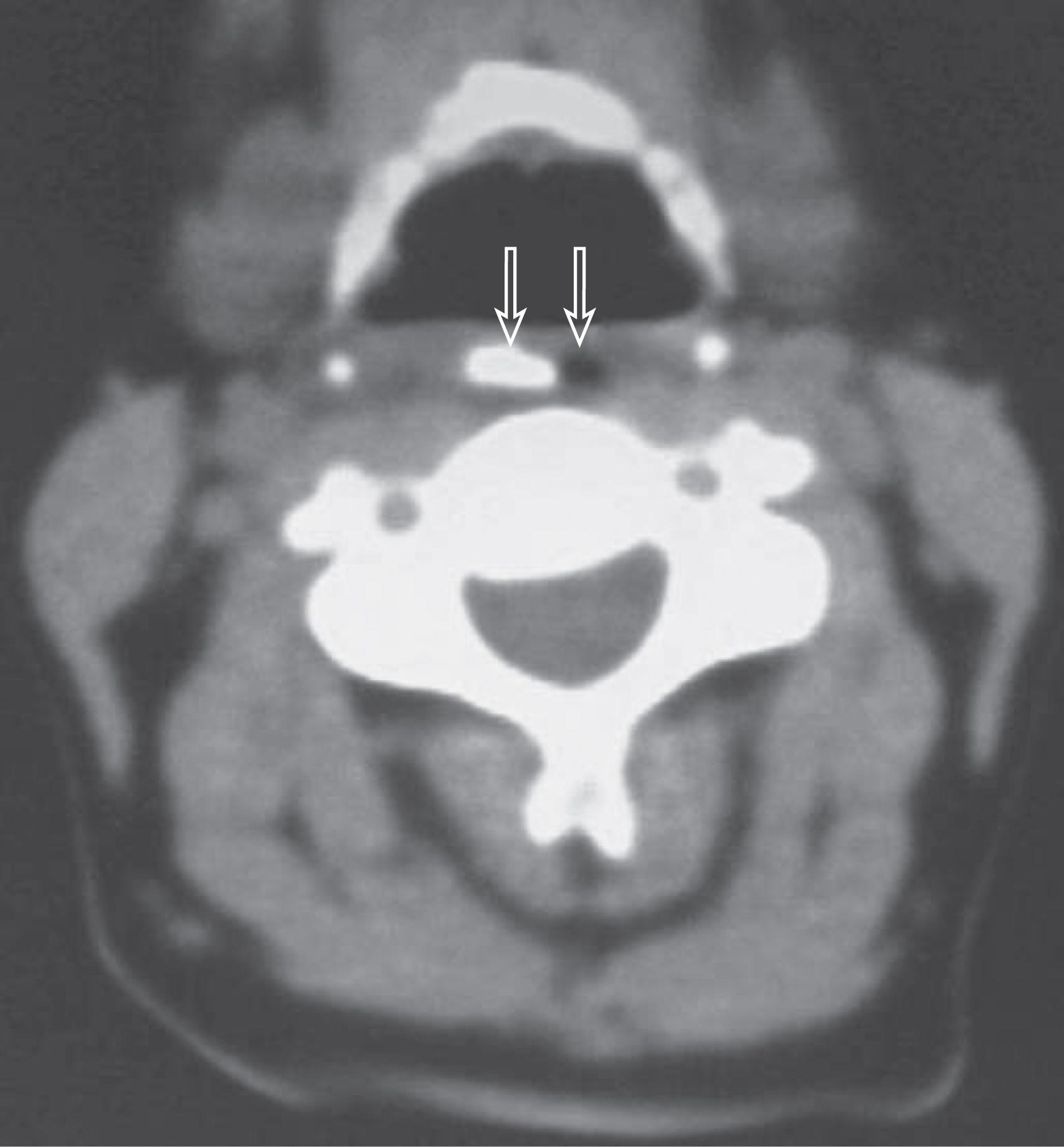 FIGURE 6, Retropharyngeal air as seen on a noncontrast CT scan of the neck.
