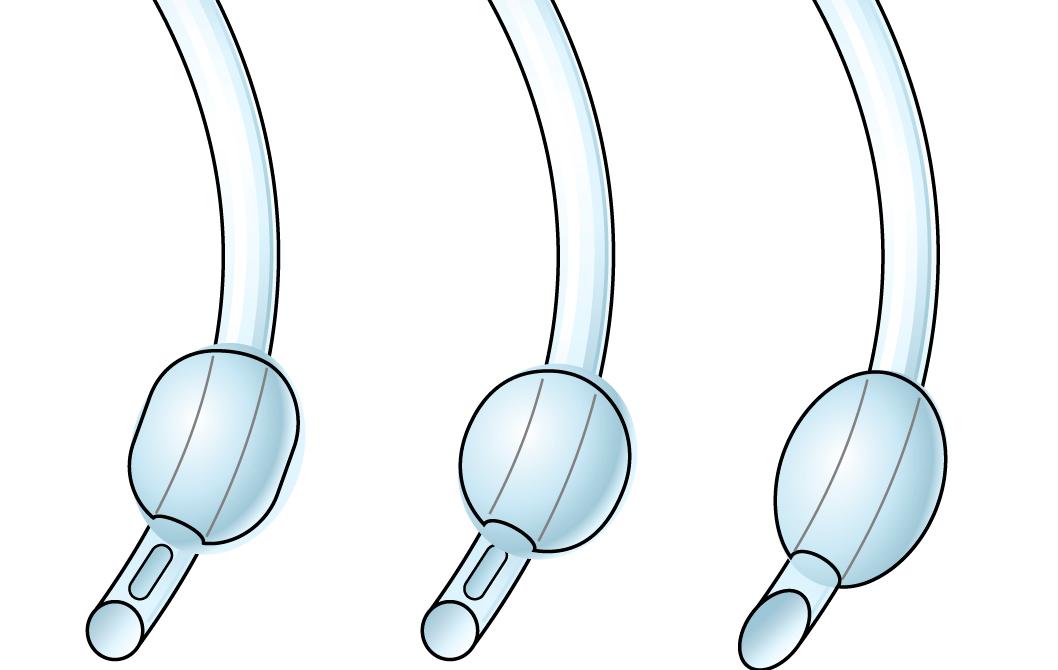 Fig. 5.5, Different types of tracheal tube cuffs. High volume (left) , intermediate volume (centre) , low volume (right) .