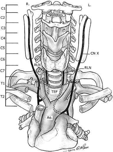 FIGURE 52-1, Schematic demonstrating course of recurrent laryngeal nerve (RLN) on each side. Tracheoesophageal fascia (TEF) is partially peeled away. Ao., Aorta; CN, cranial nerve; L., left; R., right.