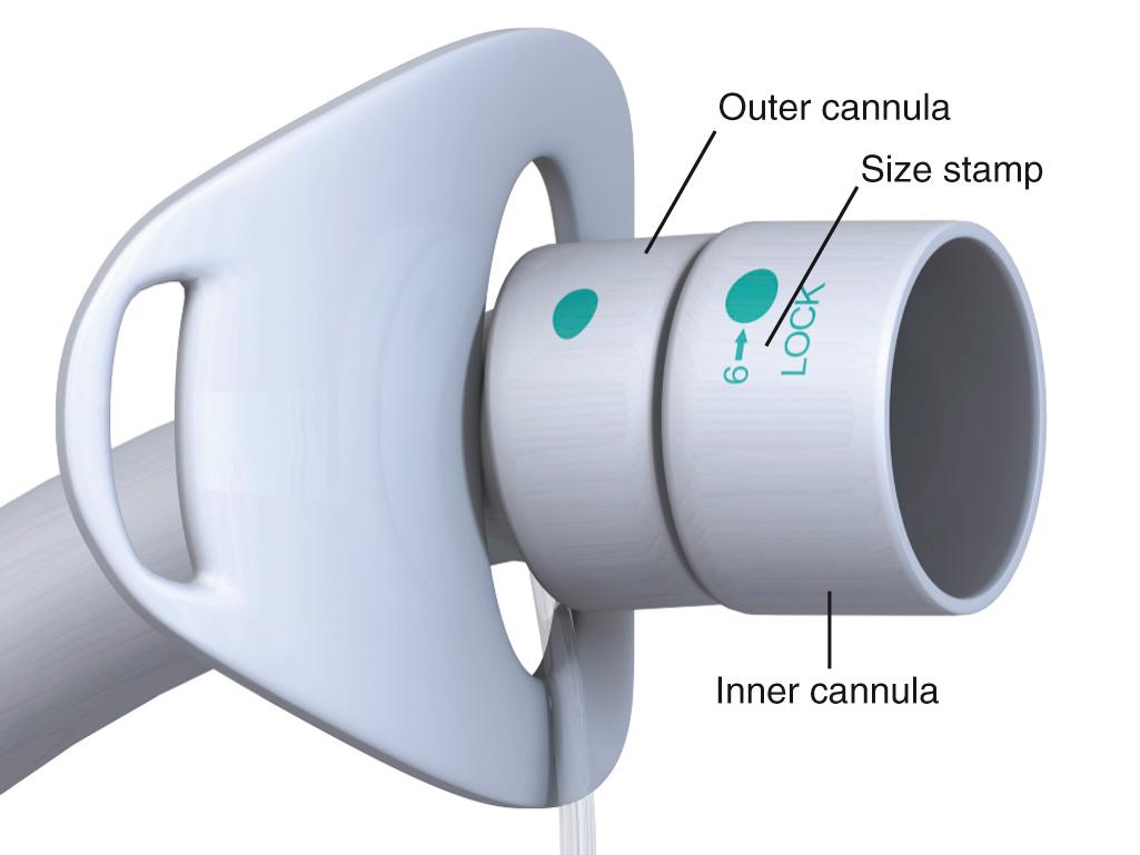 Figure 7.4, Close-up of a Shiley tracheostomy tube. Note that only the inner cannula has a 15-mm adapter that will accept an Ambu bag or a ventilator; the outer cannula will not. The inner cannula MUST be in place to ventilate the patient.