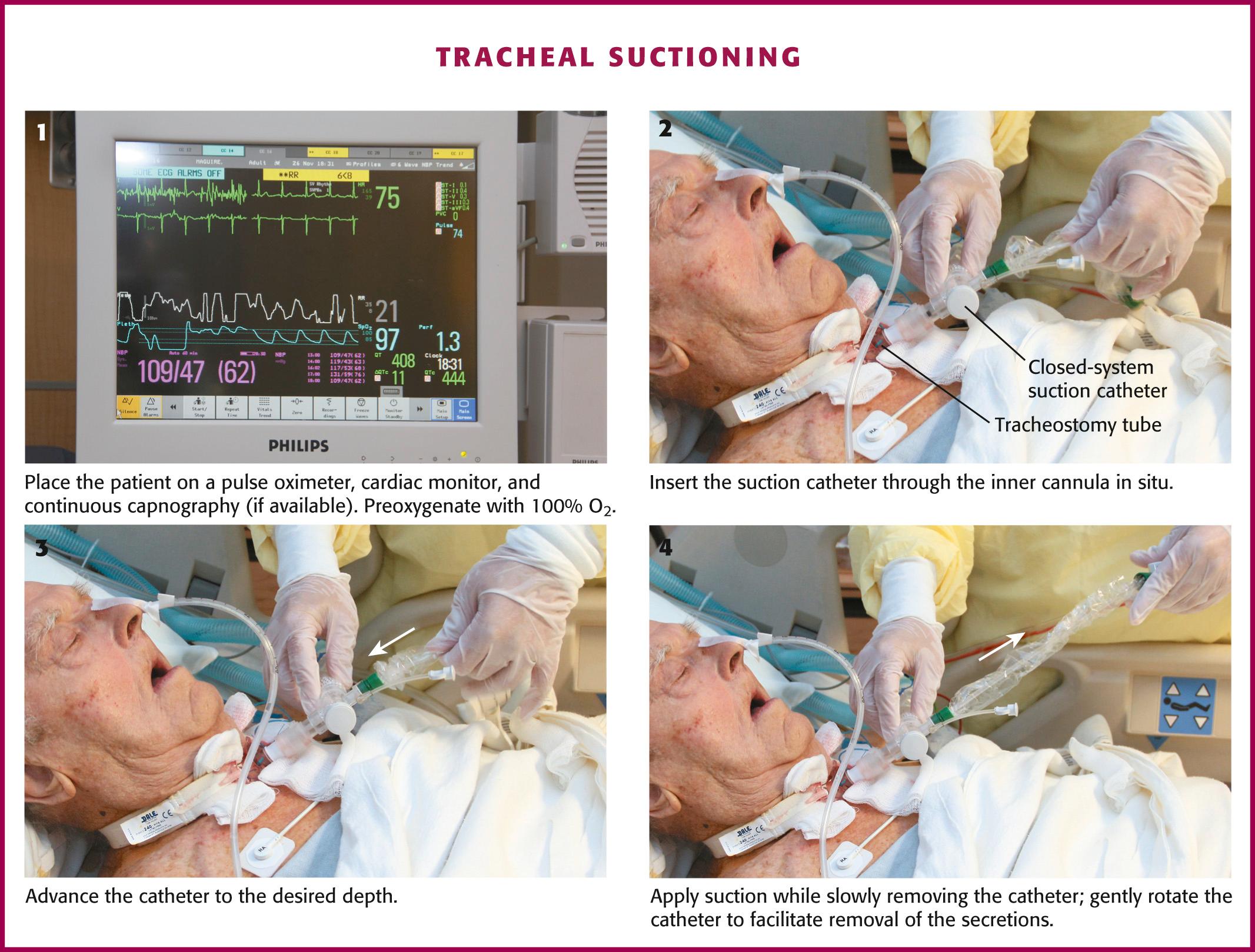 Figure 7.6, Tracheal suctioning.