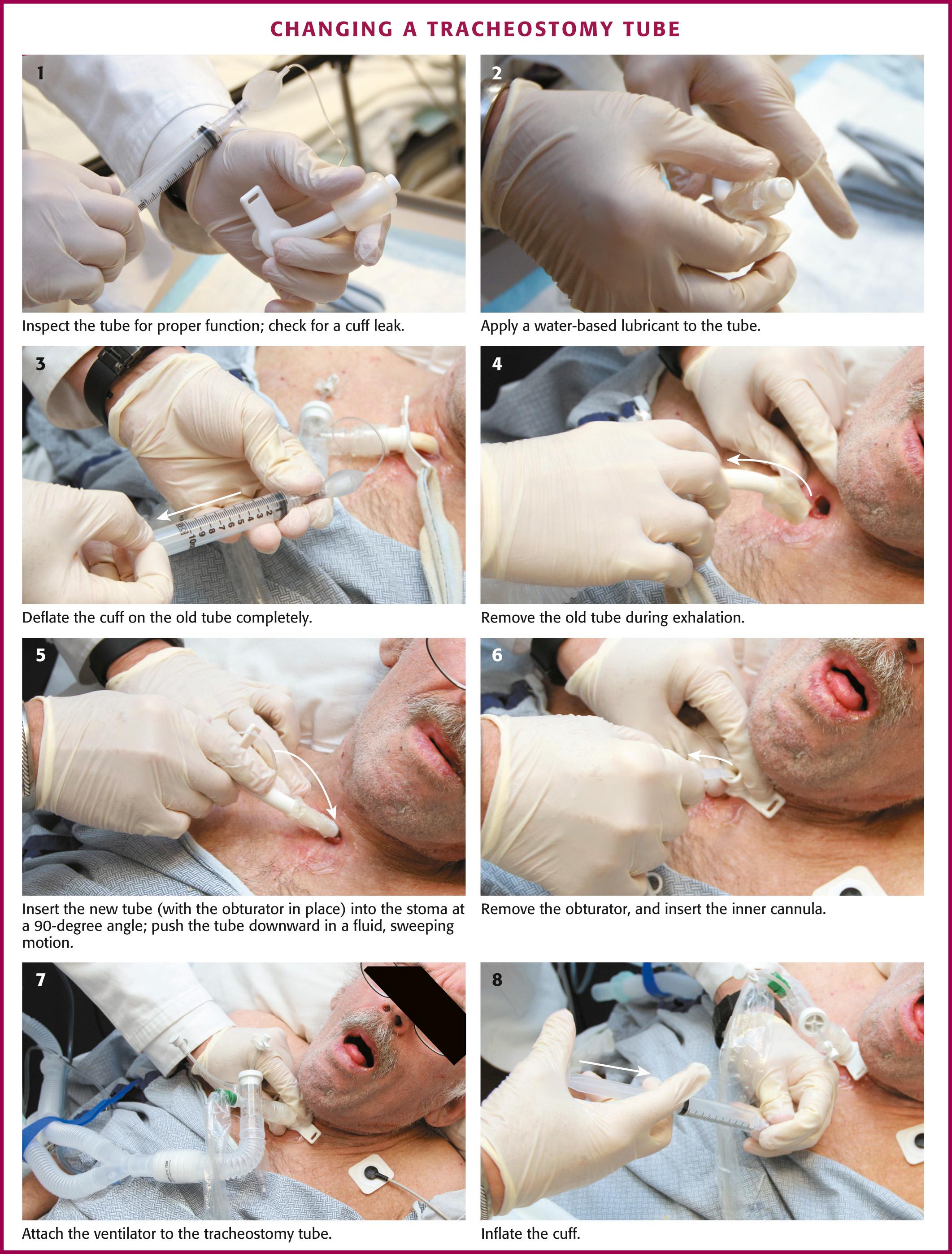 Figure 7.7, Changing a tracheostomy tube. Maintain the neck in the same position (slightly extended) for removal and insertion so that the tract is not lost. If the tube is already out, and the specifics of the tract are unknown, extending the neck to align the stoma with the tissue tract is the first best position for tube replacement.