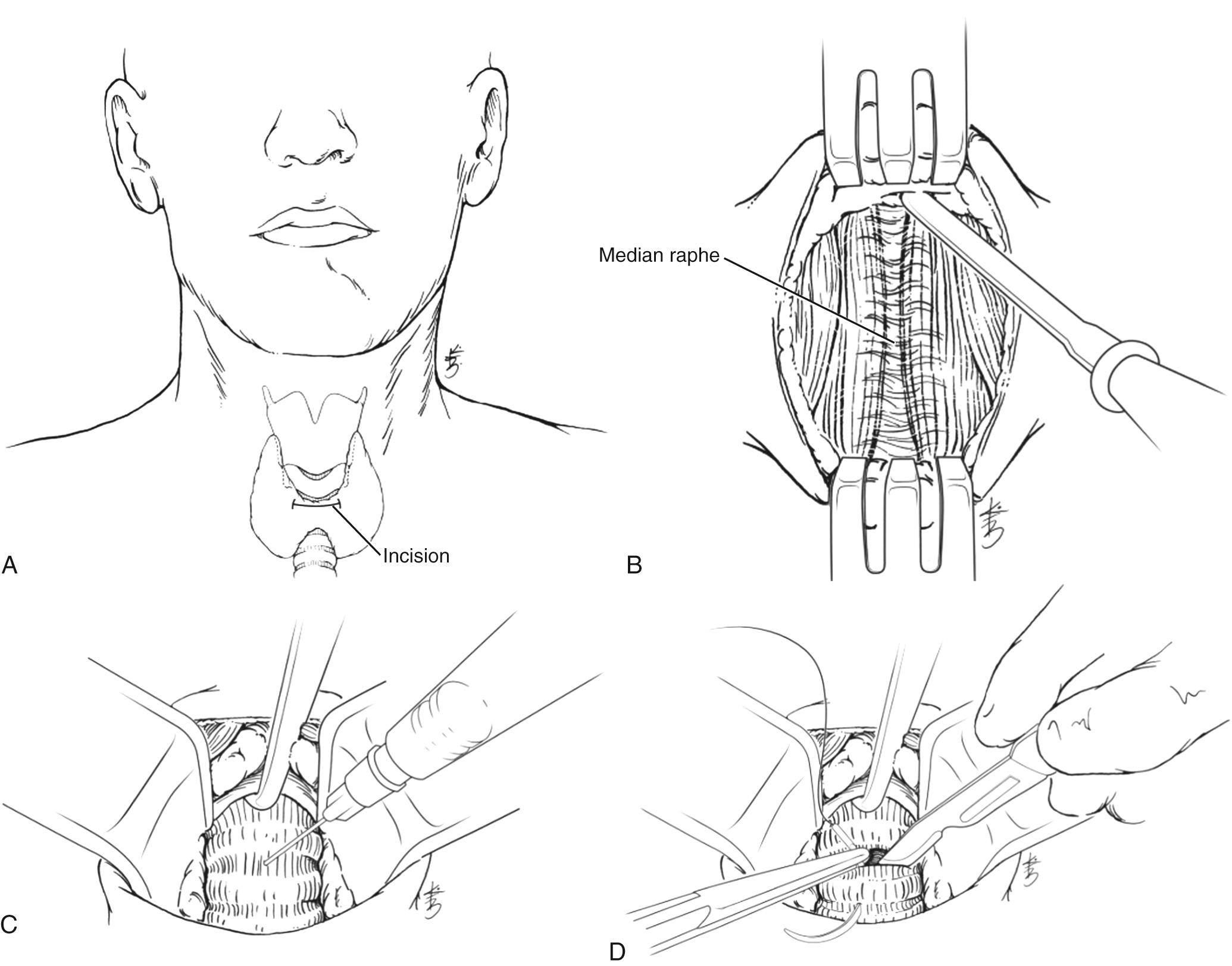 Fig. 7.2, (A) Favorable position of incision below the inferior border of the cricoid. (B) The midline raphe of the strap muscles is divided, and the muscles are reflected laterally. (C) The cricoid hook can be used to immobilize and secure the trachea prior to entering the airway. (D) The airway is entered between rings two and three or rings three and four. The inferior ring can be secured with a suture to facilitate easy access, should the patient be accidentally decannulated.