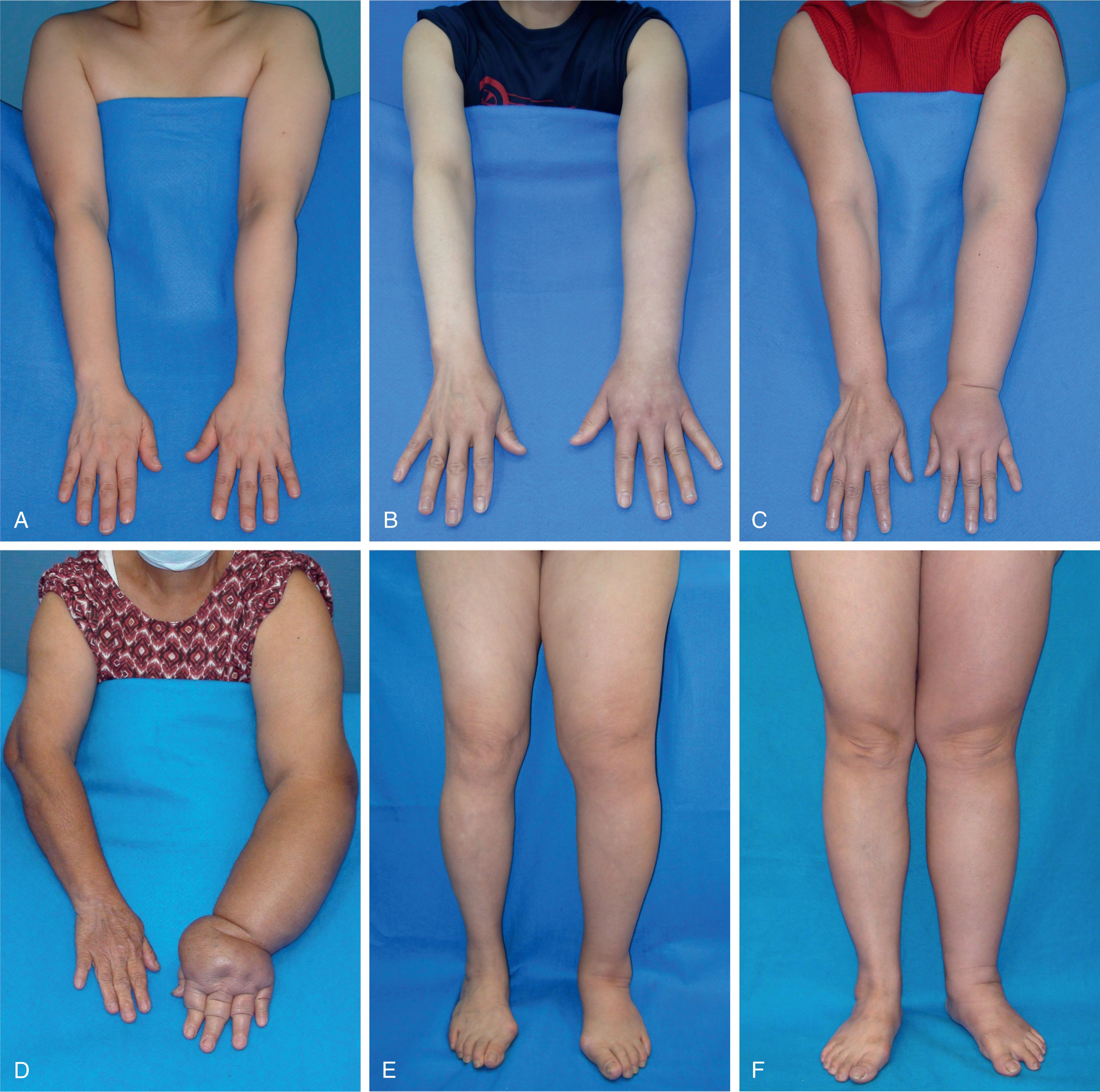 Fig. 26.1, Examples of lymphedema grade 1, 2, 3, and 4 according to Cheng’s grading system for left upper (A–D) and lower (E–H) limb lymphedema. Grade 0 has a near-normal limb appearance with abnormal lymphoscintigraphy findings and is therefore not illustrated.