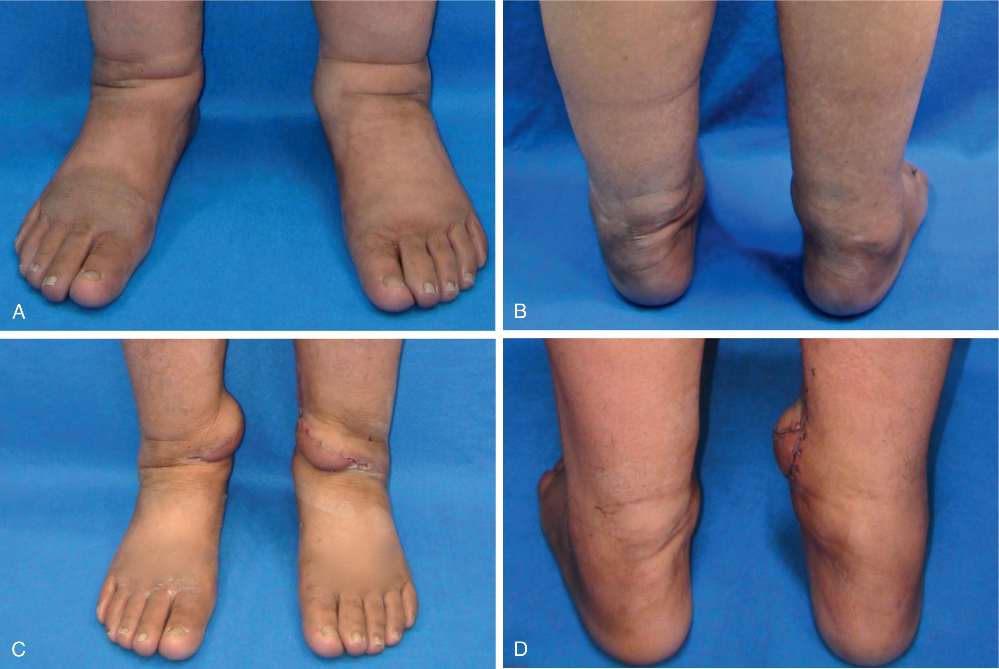 Fig. 26.2, Preoperative photographs (A, B) of the bilateral lymphedematous feet documenting fungal infection and dermatitis. Photographs at 2 months after vascularized submental lymph node flap transfer to the ankle (C, D) show subsided fungal infection and improved dermatitis.