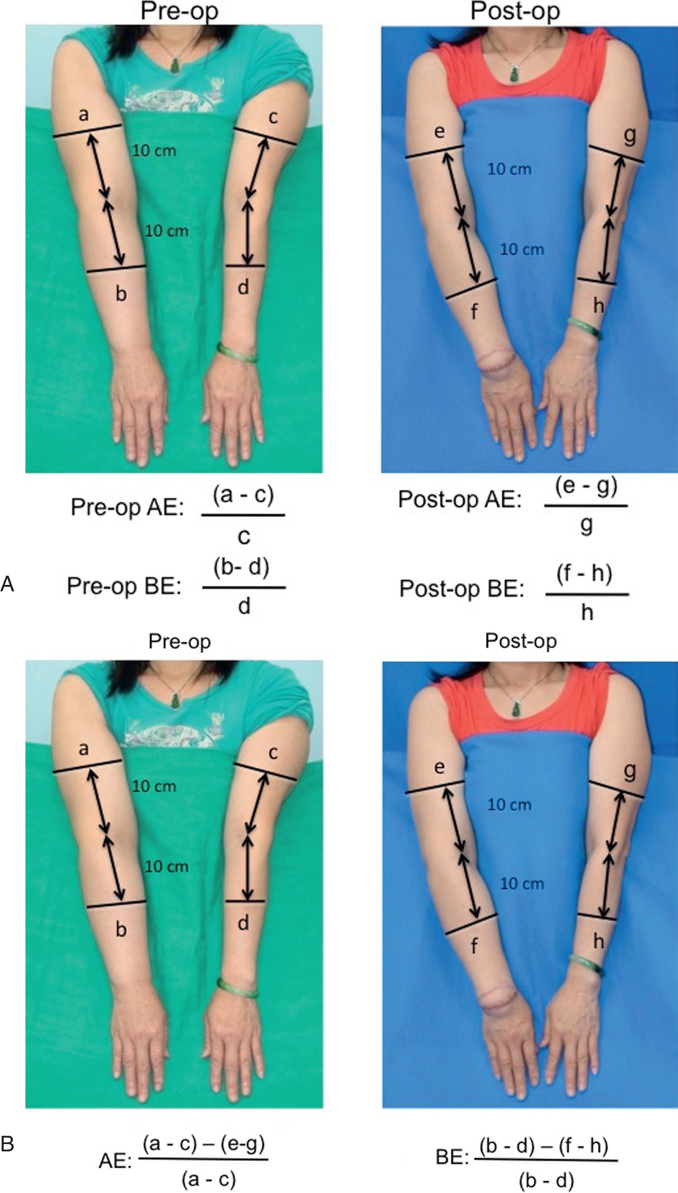 Fig. 26.3, Circumferential difference and reduction rate for upper (A, B) and lower (C, D) limb lymphedema. Such measurement is practical in many settings, is reproducible, and facilitates communication between healthcare professionals. It is easy to track limb size changes preoperatively and postoperatively. AA , Above ankle; AE , above elbow; AK , above knee; BE , below elbow; BK , below knee.