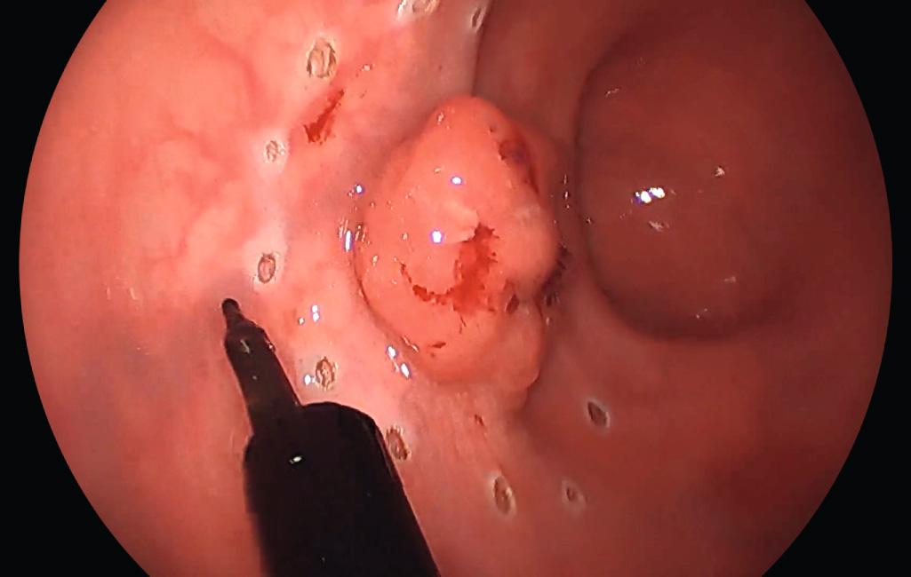 FIGURE 167A.2, Lesion being marked out during transanal minimally invasive surgery local excision. Monopolar cautery device is used to score the rectal mucosa with a 1 cm circumferential margin.