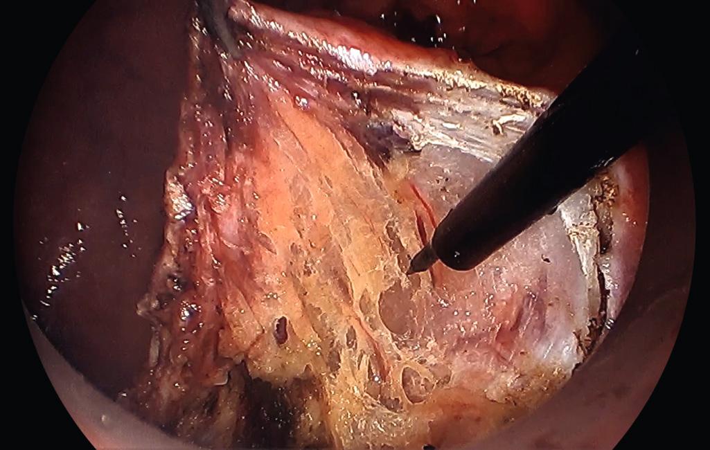 FIGURE 167A.3, Full-thickness excision. Note the mesorectal fat underneath the lesion, signifying that entire rectal wall has been transected.