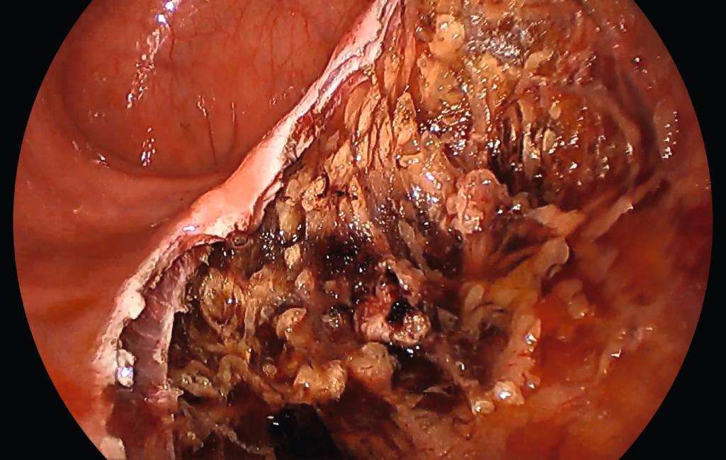 FIGURE 167A.5, Rectal wall defect after being irrigated with dilute povidone-iodine (Betadine), prior to closure.