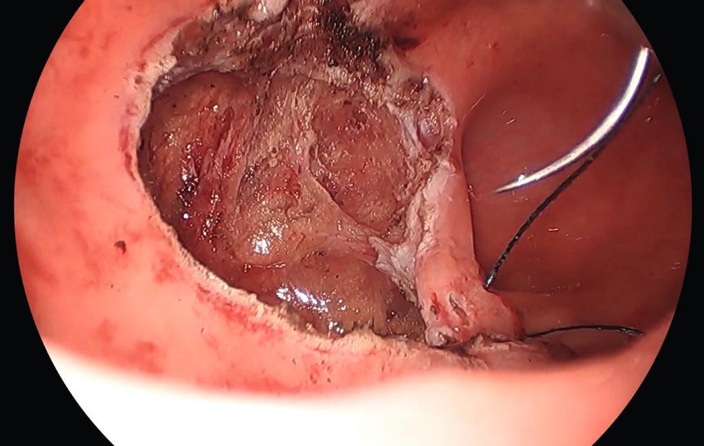 FIGURE 167A.6, Rectal wall defect being closed using continuous V-Loc suture.