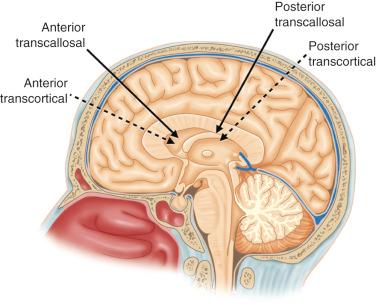 Figure 14.1, Management of tumors of the anterior third and lateral ventricles. Transcortical and transcallosal routes. The transcortical route allows access to more anterior or posterior areas compared to the transcallosal approach, which is more limited.