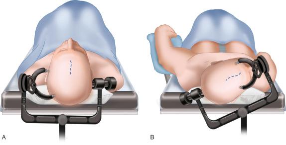 Figure 14.2, The patient can be placed in the supine position (A) with the head rotated towards the contralateral side (B). An alternative is the lateral decubitus position.