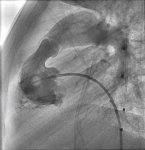 Fig. 60.1, Lateral right ventricular angiogram in a child with congenital pulmonary valve stenosis.