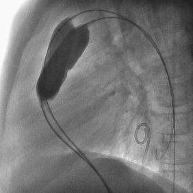 Fig. 60.2, Double-balloon pulmonary valve dilation in a child with pulmonary valve stenosis.