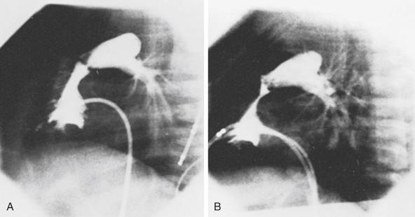 Fig. 60.3, Lateral right ventricular angiogram before (A) and immediately after (B) valvuloplasty in an infant with pulmonary stenosis. There is marked systolic narrowing of the right ventricular infundibulum after valvuloplasty that was not present before the procedure. Such dynamic infundibular narrowing may account for some residual gradient that may be measured immediately after the procedure and typically improves with time.