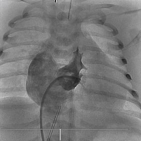 Fig. 60.4, Anteroposterior right ventricular angiogram in a newborn with pulmonary valve atresia and right ventricular hypoplasia. The right ventricle is small, and its outflow tract is evident immediately beneath the imperforate pulmonary valve. There was significant tricuspid regurgitation.