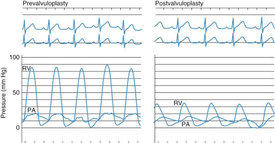 Fig. 60.5, Simultaneous right ventricular (RV) and pulmonary artery (PA) pressure recordings before and immediately after pulmonary valve dilation in a 15-month-old boy with severe pulmonary stenosis. The right ventricular systolic pressure was reduced from 86 to 36 mm Hg. The pulmonary valve systolic gradient decreased from 66 to 20 mm Hg (pressure recordings were made on the same scale).