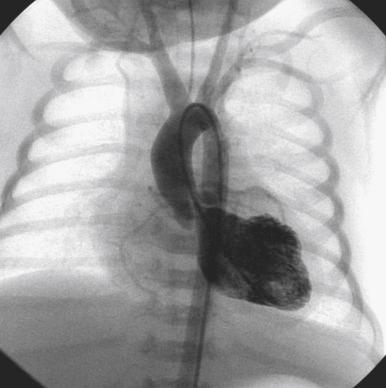 Fig. 60.6, Anteroposterior left ventricular angiogram in a newborn with critical aortic valve stenosis. The aortic valve leaflets are thickened, and there is severe left ventricular dysfunction.