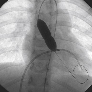 Fig. 60.7, Balloon dilation in a child with severe aortic valve stenosis.