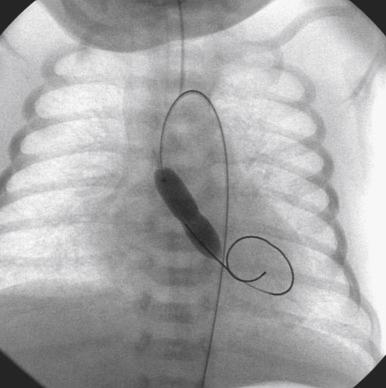 Fig. 60.8, Balloon dilation in a newborn with critical aortic stenosis (same patient as in Fig. 60.6 ).