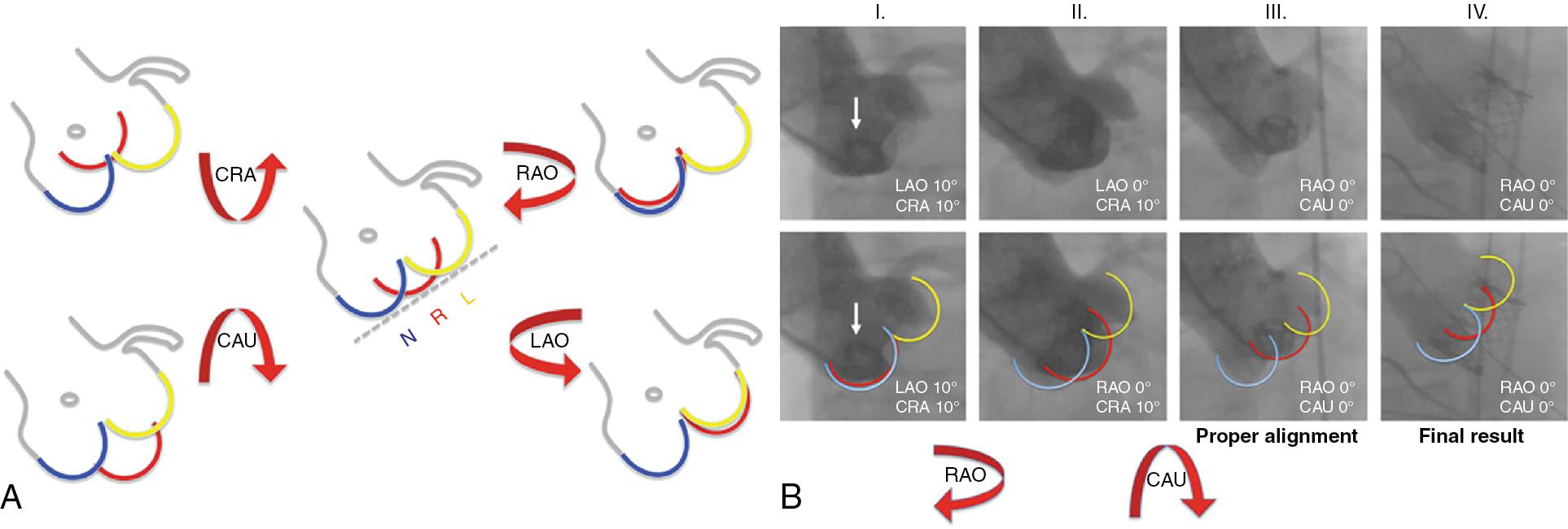 Fig. 10.2, (A) Schematic illustration of the “follow the right cusp” rule pointing to the proper alignment in the case of normal aortic root anatomy. (B) A step-by-step approach: a pigtail catheter is placed in the right cusp as a reference and an LAO 10-degree CRA 10-degree aortogram is performed. If the right cusp is located on the “right” side behind the noncoronary cusp, the C-arm must be led to an RAO projection in order to follow the right cusp. After the projection view has been changed, the right cusp will appear in the middle, but still deeper than the other cusps. Once again, follow the right cusp by turning the C-arm clockwise to the CAU direction. After alignment is obtained, providing that the most caudal attachments of all three of the aortic leaflets result in one axial image, a final angiogram can be performed to confirm the working projection step-by-step approach. CAU, Caudal; CRA, cranial; L, left coronary cusp; LAO, left anterior oblique; N, noncoronary cusp; R, right coronary cusp; RAO, right anterior oblique.