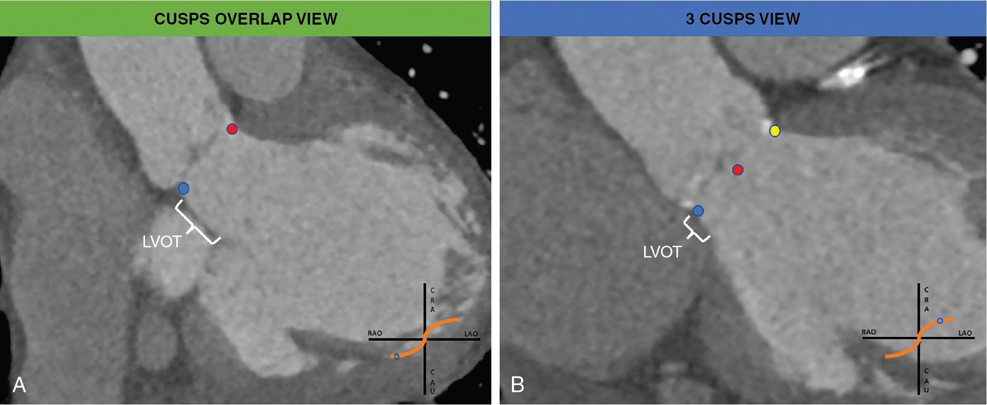 Fig. 10.3, (A) A computed tomography slice shows the “cusps overlap view.” The optimal projection curve (S-curve) is plotted as an orange line; the region of fluoroscopic angulation corresponding to the “cusps overlap view” is indicated by green circle. (B) A computed tomography slice shows the “3 cusps view.” The optimal projection curve (S-curve) is plotted as an orange line; the region of fluoroscopic angulation corresponding to the “3 cusps view” is indicated by the blue circle. The white signs indicate the LVOT lengths in either “cusps overlap” or “3-cusp” view. LVOT , Left ventricular outflow tract.