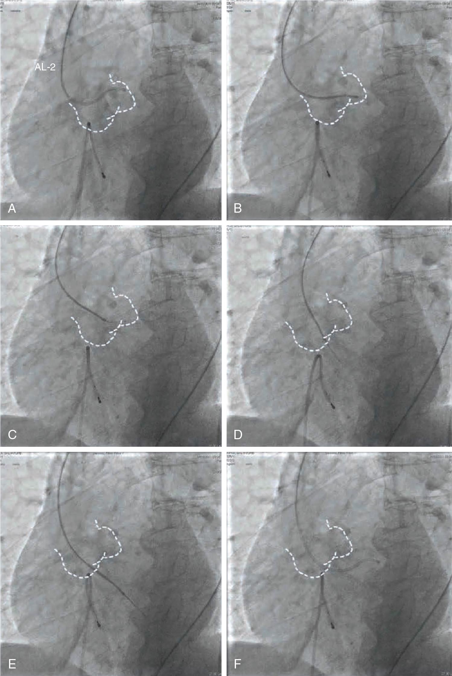 Fig. 10.6, Aortic Valve Crossing.