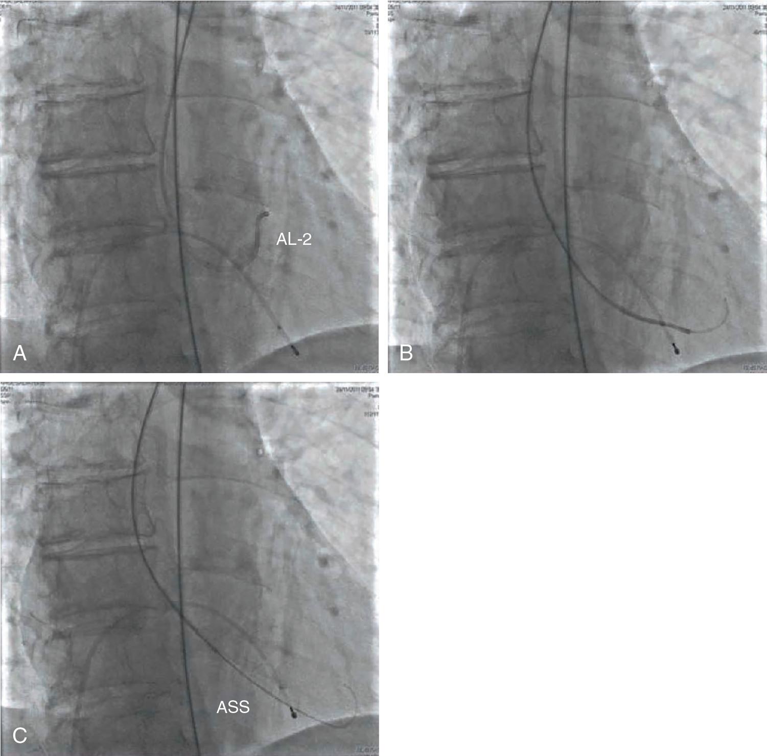 Fig. 10.8, In expert hands, after advancing the Amplatz left curve 2 catheter (AL-2) into the left ventricle (LV) (A), exchange the straight-tip guidewire for the Amplatz Super Stiff (ASS) guidewire (B). Using a right anterior oblique projection, position it in the apex of the LV (C).