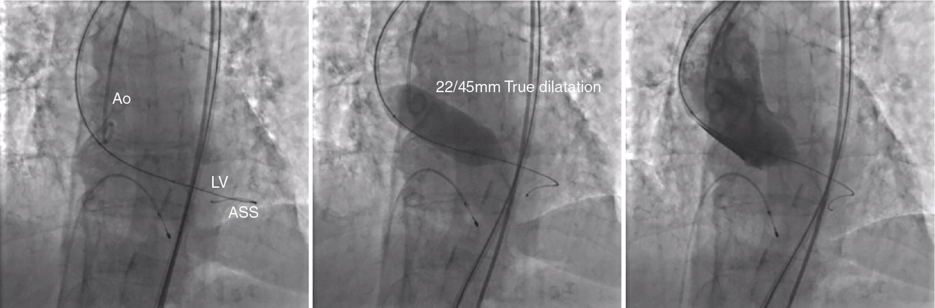 Fig. 10.10, Balloon Aortic Valvuloplasty With Simultaneous Aortography Performed During Rapid Pacing With True Dilatation Balloon (see Video 10.4 ).