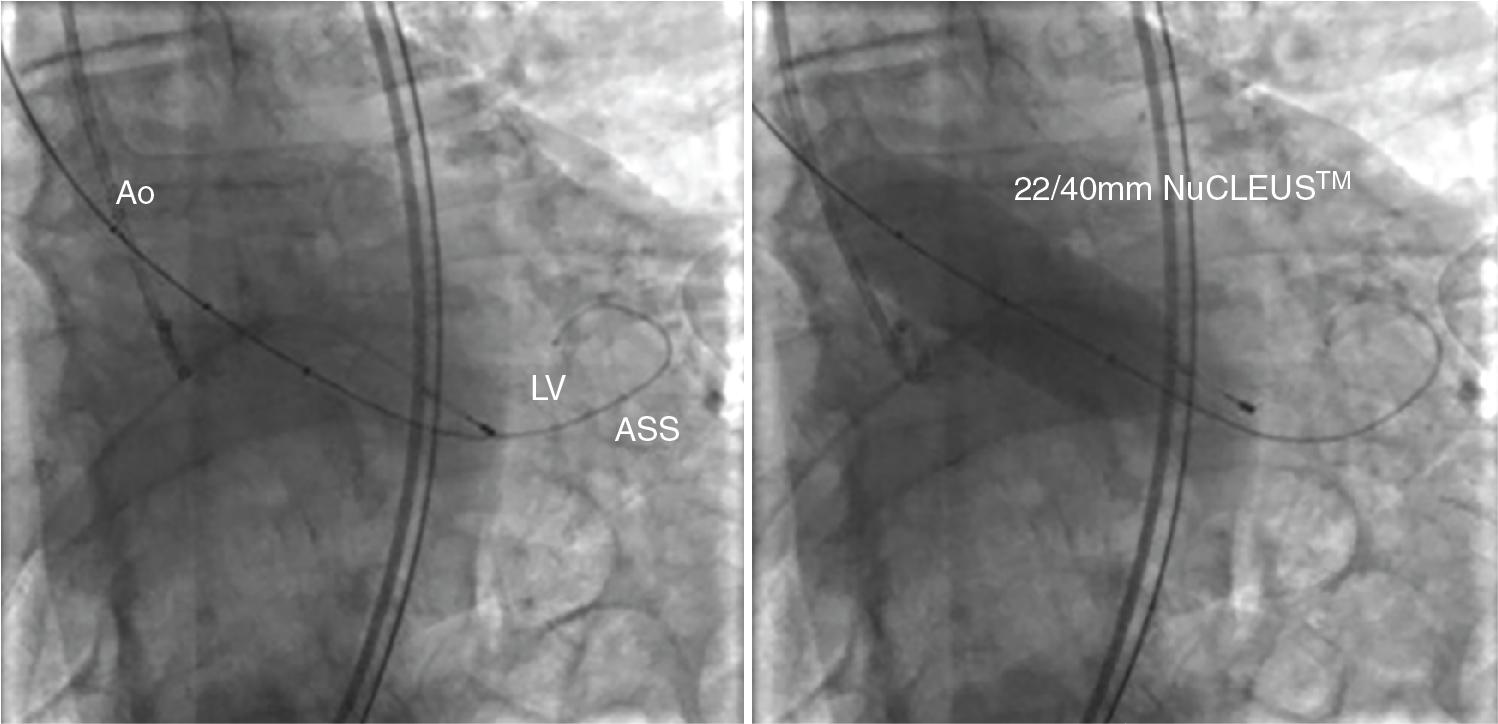 Fig. 10.9, Balloon Aortic Valvuloplasty With NuCLEUS Balloon (see Video 10.3 ).