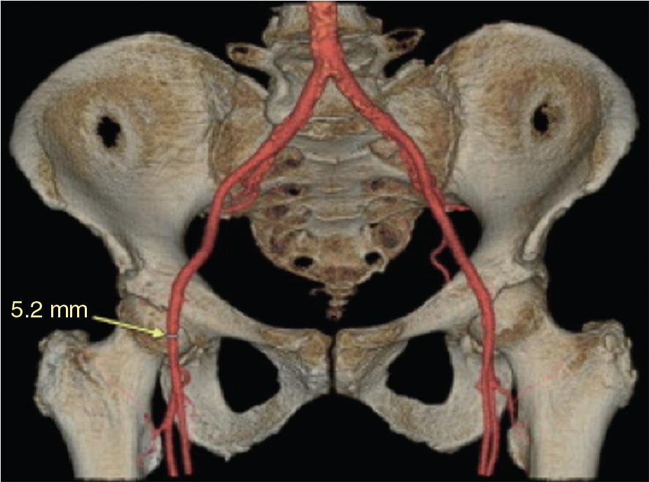 Fig. 13.1, Three-Dimensional (3D) Volume-Rendered Image of Iliofemoral Vasculature and Bony Pelvis Assessed by MDCT.
