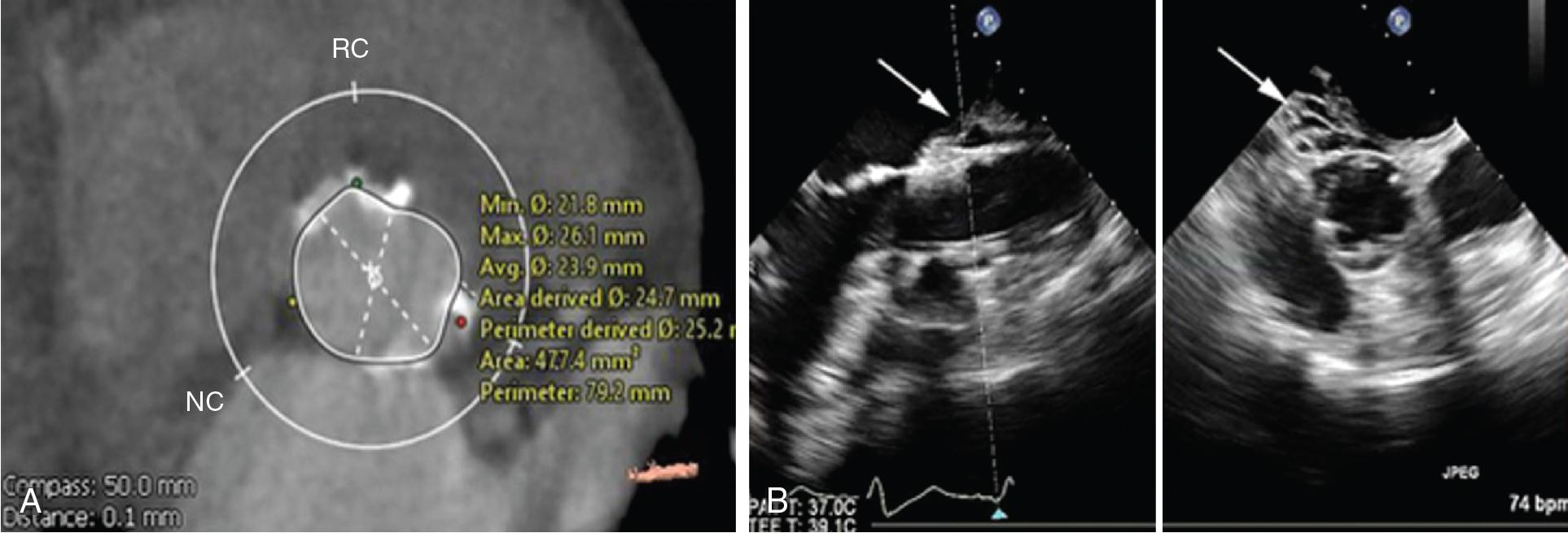 Fig. 13.3, Aortic Valve Annular Rupture During Transcatheter Aortic Valve Replacement.