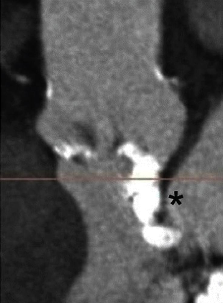 Fig. 13.4, Aortomitral Continuity Calcification.