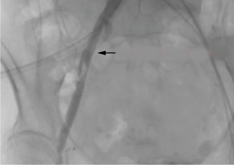 Fig. 13.5, Postprocedure invasive angiography shows the external iliac artery dissection with thrombus (arrow).