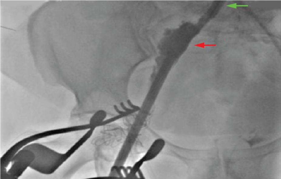 Fig. 13.6, Postprocedure retrograde angiogram shows contrast extravasation from right external iliac artery, which is diagnostic of perforation and rupture (red arrow). An occlusive balloon is noted proximal to the site of vessel injury (green arrow).