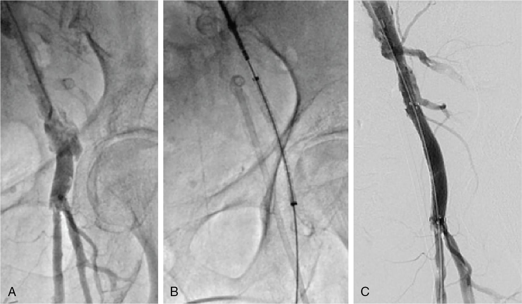 Fig. 13.7, Treatment of Femoral Artery Injury With a Covered Stent.