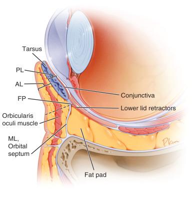 Figure 12.1, Sagittal section of the lower eyelid demonstrating the AL (skin/muscle) and PL above (tarsus/conjunctiva) and below (lower lid retractors/conjunctiva) the tarsus. The FP of the lower lid retractors and orbital septum, the ML (orbital septum), and fat pads are also shown. The FP is critical for incision placement during surgery. AL , Anterior lamella; FP , fusion point; ML , middle lamella; PL , posterior lamella.