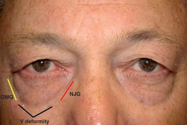 Figure 12.3, Lower periorbital hollows: red, NJG; black, V deformity; yellow, OMG. NJG , Nasojugal groove; OMG , orbitomalar groove.