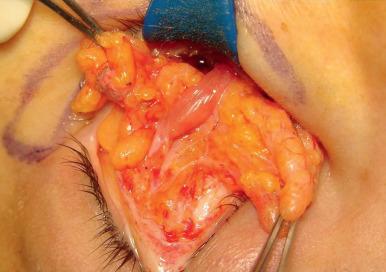 Figure 12.5, Free movement of nasal and central fat on the undersurface of the inferior oblique muscle: the “inverse shoe shine sign.”