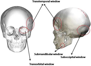 Figure 5.1, Schematic diagram showing various windows used for insonation of intracranial vessels.