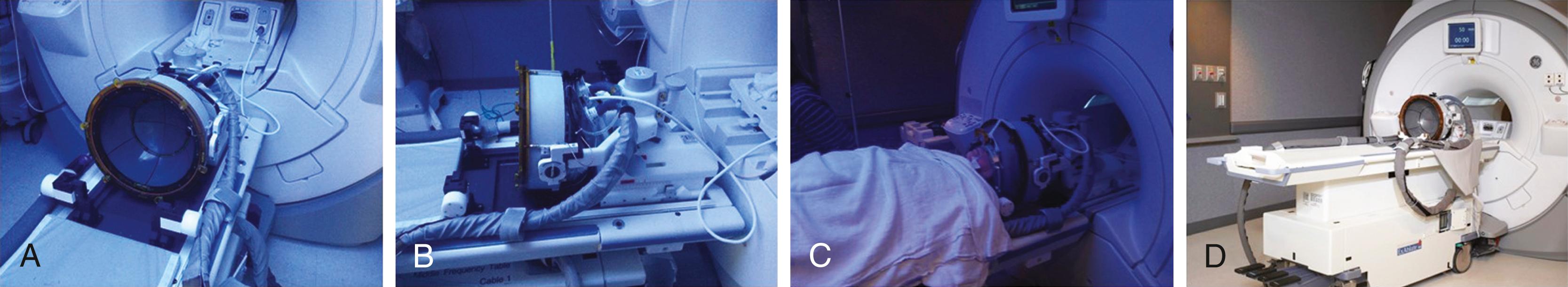 Figure 117.1, ExAblate 4000 ultrasound device (Insightec, Haifa, Israel). Hemispheric phased-array configuration of 1024 individual elements seen from below (A) and from a lateral view (B). (C) A patient is secured to the MRI table and ultrasound device in a stereotactic frame. The white membrane couples the ultrasound device to the patient’s head with chilled, degassed water. (D) Full view of the ultrasound device, MRI bore, and table.