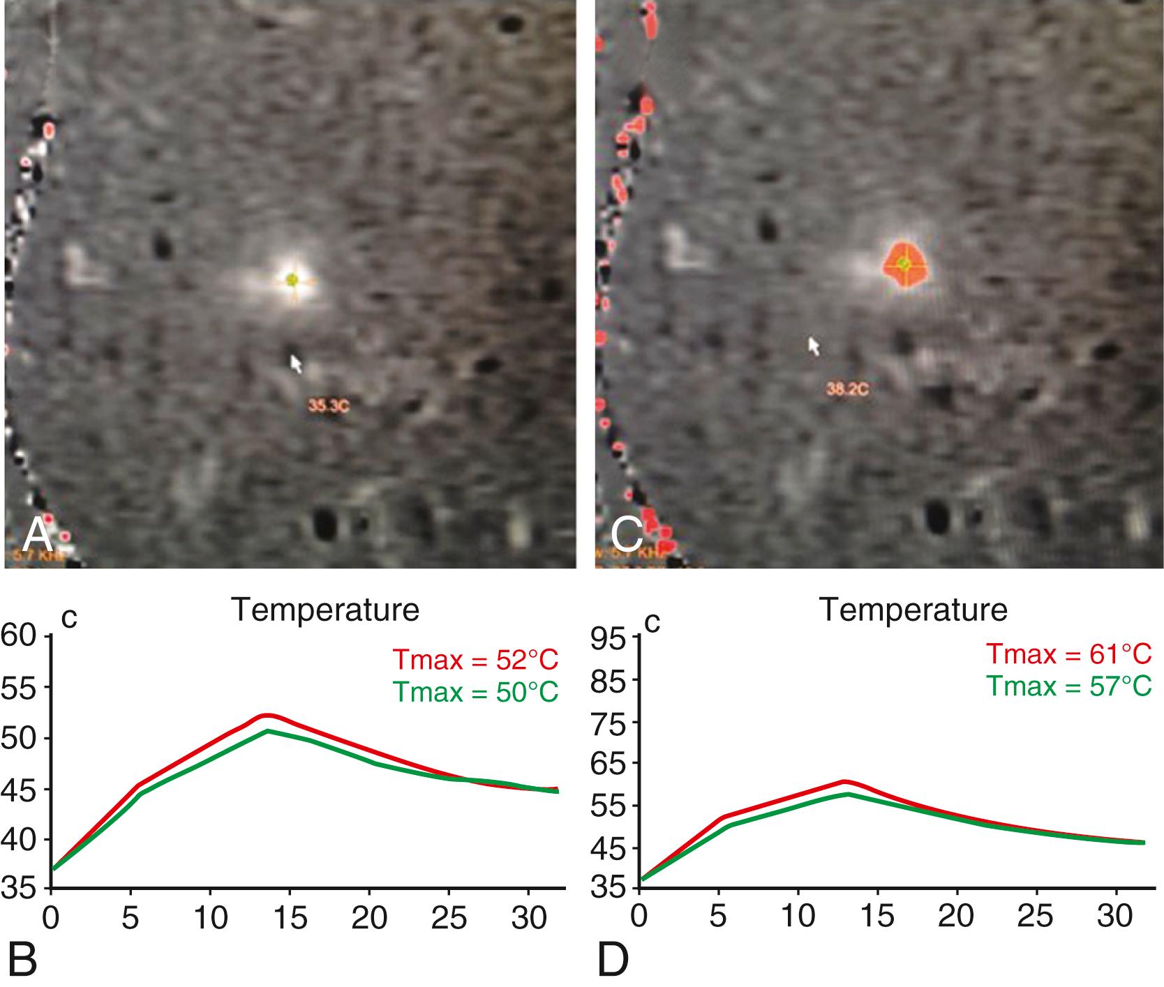 Figure 117.2, Intraprocedural magnetic resonance (MR) thermography.