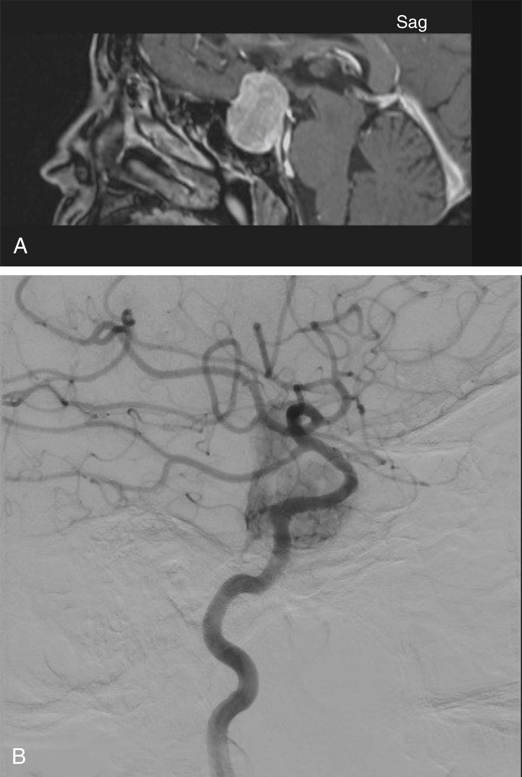 FIGURE 16.1, (Case 1) A 53-year-old female who presented with left eye blurriness that started 2 months before surgery. The MRI showed a pituitary macroadenoma. An endoscopic transnasal, transsphenoidal approach was performed. After opening the dura and coagulation of enlarged and arterialized intercavernous sinuses, just working in the midline, there was major vascularity of the tumor, which significantly hampered the surgeon’s ability to safely remove the tumor. As a result, only partial debulking was performed and the patient was brought to the Interventional Radiology suite for angiography. The patient was consulted for tumor debulking and chiasm decompression via supraorbital approach. (A) Preoperative sagittal T1 MRI with contrast. (B) Postoperative angiography showed a hypervascular sellar lesion and hypertrophy of the inferior hypophyseal artery. MRI , Magnetic resonance imaging; sag , sagittal.