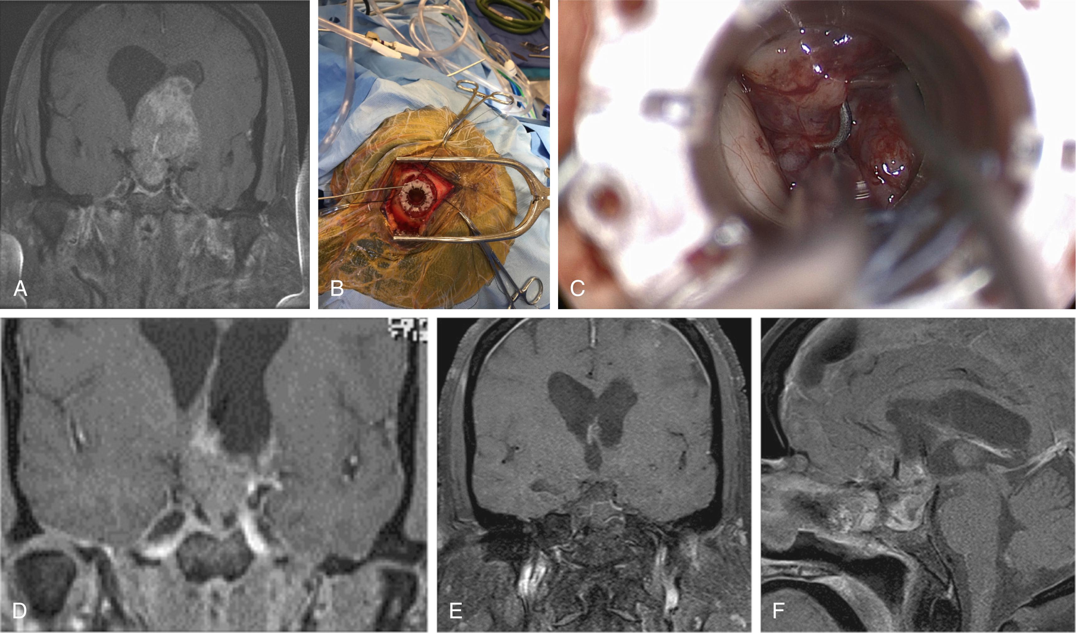 FIGURE 16.2, (Case 2) A 51-year-old female with a past medical history of pituitary adenoma status post endonasal resection in 2008 who presented with progressive vision decline. MRI revealed massive greater than 6 cm recurrence of her pituitary adenoma with obstructive hydrocephalus. A two-stage operation was planned for resection of the tumor. The first stage was for a BrainPath assisted craniotomy and the second for a re-do endonasal approach for resecting the tumor. (A) Preoperative T1 coronal MRI with contrast. (B, C) Intraoperative picture of brain path assisted (stage 1) resection of intraventricular part of the tumor. (D) Postoperative T1 coronal MRI with contrast. (E) Postoperative T1 coronal and (F) sagittal with contrast after stage 2 (transsphenoidal) resection. MRI , Magnetic resonance imaging.