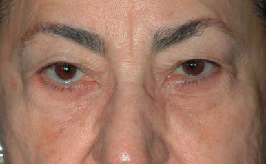 Figure 13.3, Preoperative lower eyelid laxity with scleral show. Note the problem is greater on the right. Asymmetry such as this is normal to see in patients.