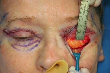 Figure 13.5, The skin flap is elevated inferiorly with sharp iris scissors for approximately 1.5 cm, preserving an intact sling of functional orbicularis muscle.