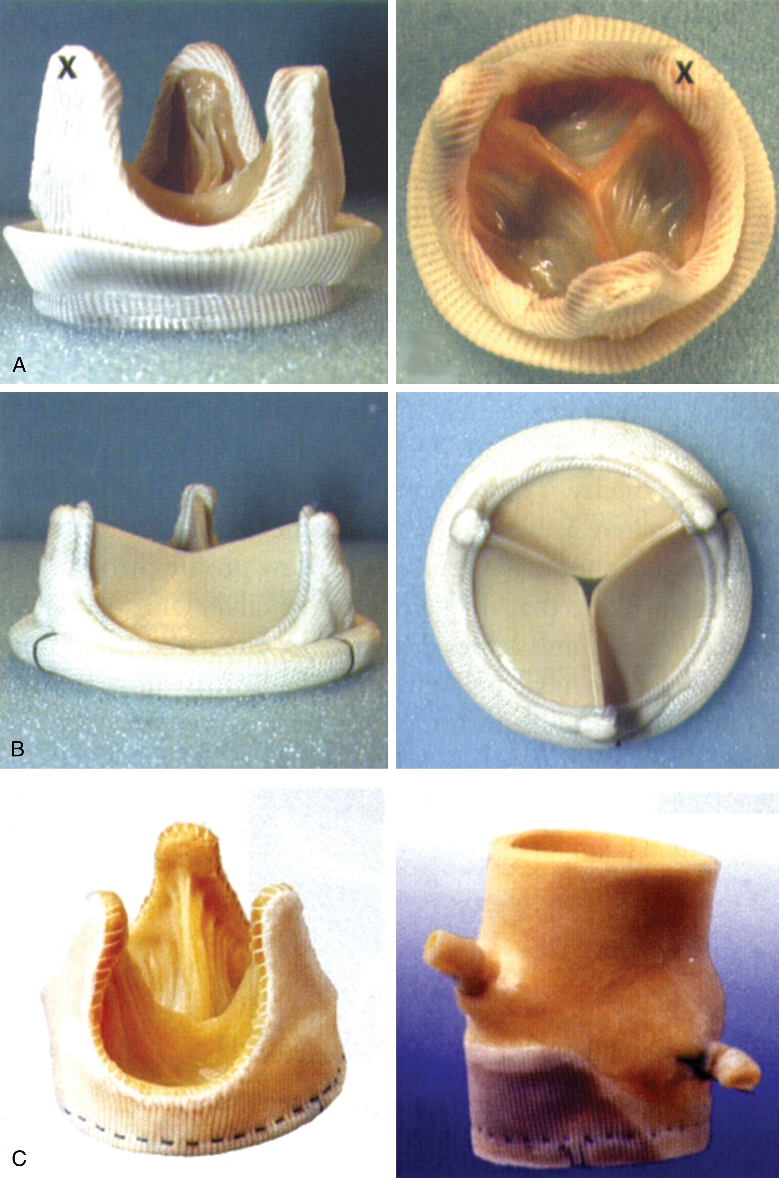 Figure 11.11, Bioprosthetic valves. Three examples of bioprosthetic or tissue valves that have been implanted into the aortic and/or mitral valve positions. (A) Hancock porcine bioprosthesis with cloth-covered stent. This valve does not have a central opening. (B) Carpentier Edwards pericardial valve. Note central opening. (C) Stentless valves with flexible and lower profile cloth-covered rim sewn into the native tissues. Left , Toronto/St. Jude Medical valve. Right , Medtronic Freestyle valve.