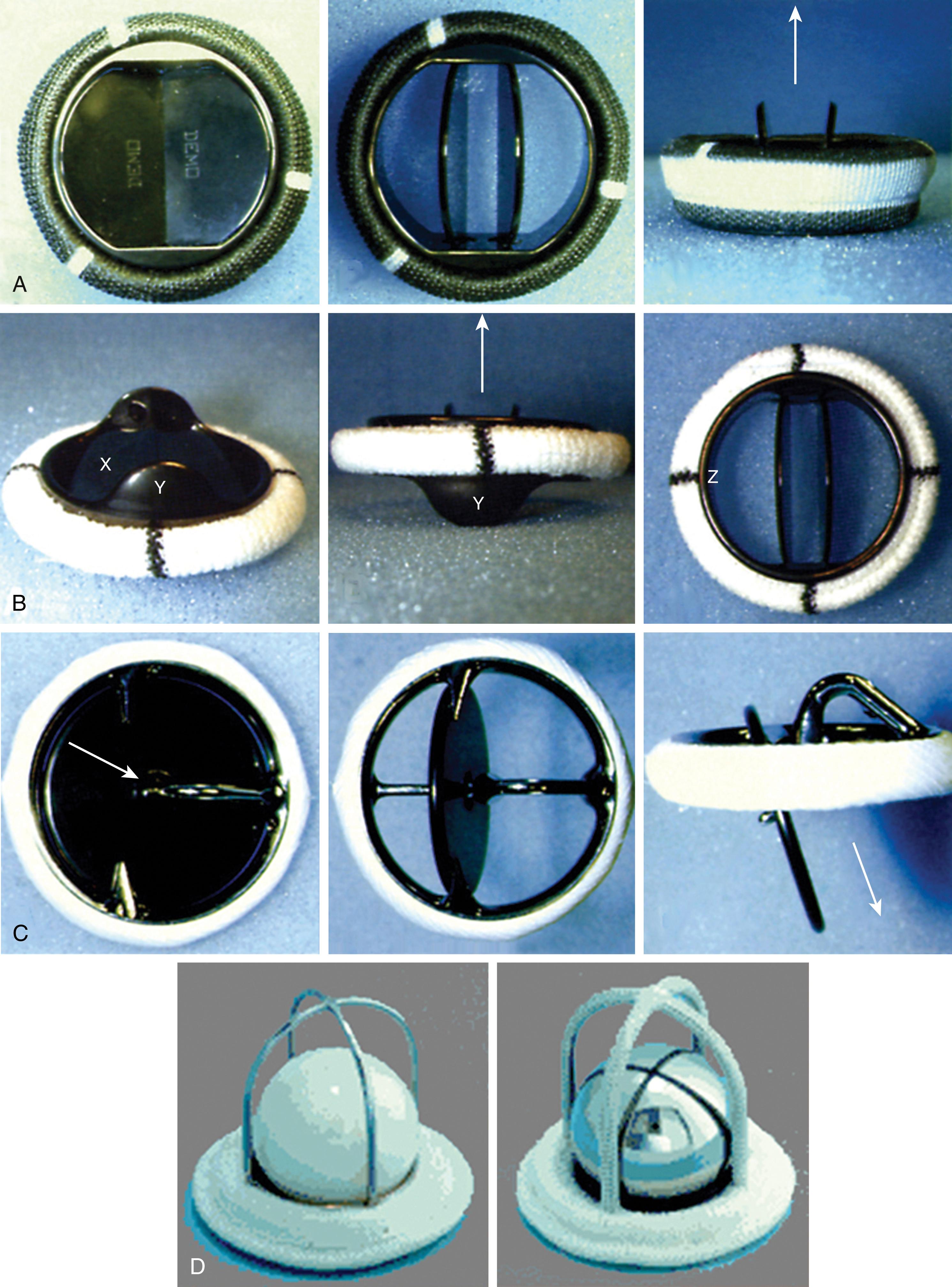 Figure 11.12, Mechanical valves. Four examples of mechanical valves placed in the aortic and/or mitral valve positions. The arrows represent the direction of blood flow through the valve. (A) and (B) Bileaflet mechanical valves represent the most common type of mechanical heart valve placed today. A difference between (A) manufactured by Carbomedics and (B) manufactured by St. Jude is the presence of a pivot guard y on the St. Jude valve. (C) Single-leaflet valve manufactured by Medtronic-Hall. (D) Starr-Edwards ball-in-cage valve, a valve that is no longer placed.